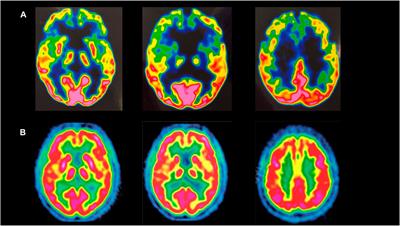 Case report: Asp194Ala variant in MFN2 is associated with ALS-FTD in an Italian family